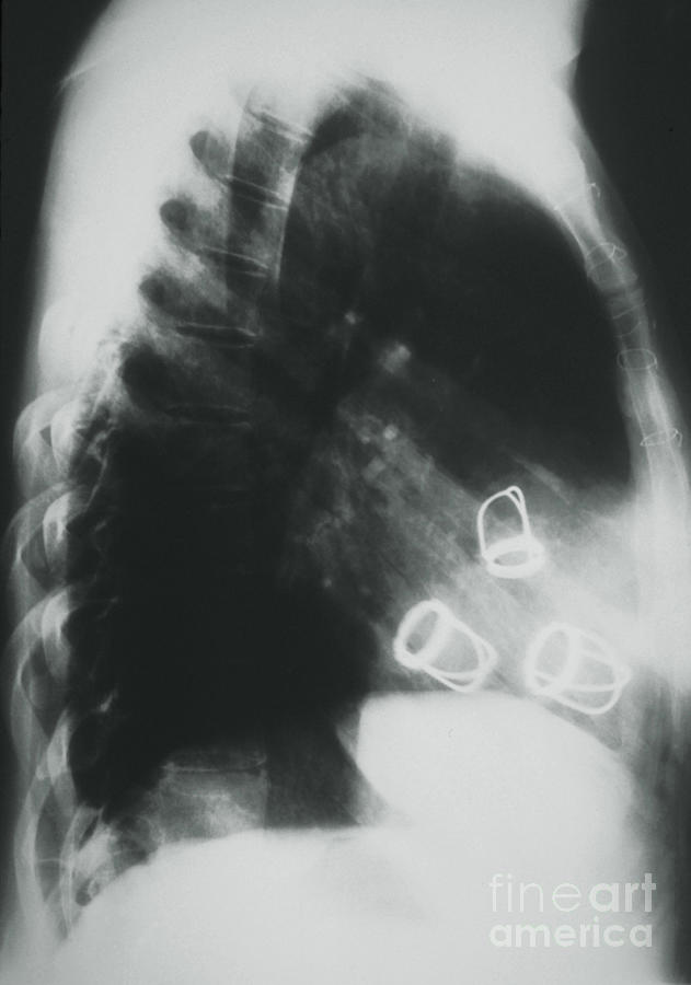 X Ray Showing Prosthetic Heart Valves In Situ Photograph By Science