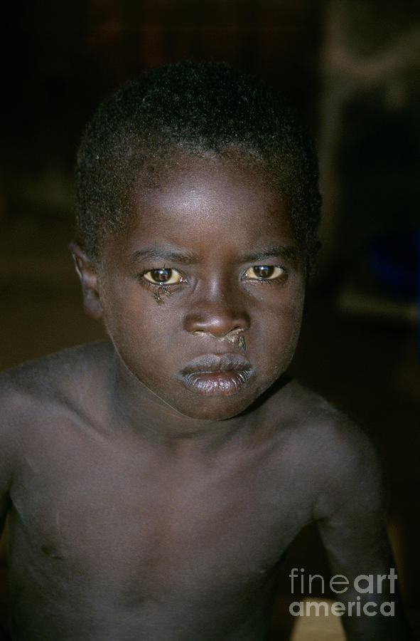 Young Child With Aids Photograph by Jason Kelvin/science Photo Library