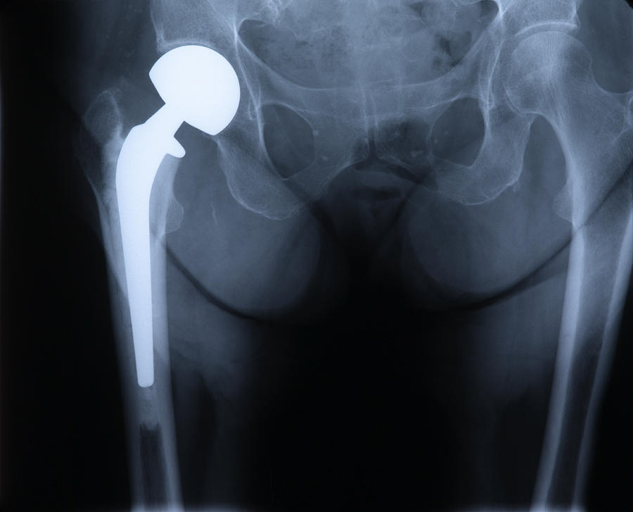  Hip replacement, x-ray Photograph by Don Farrall