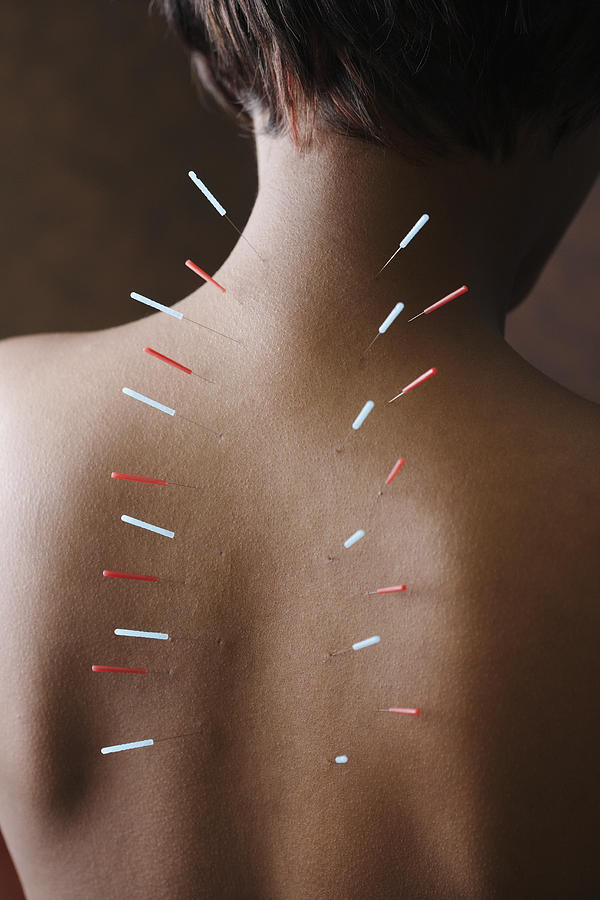 Acupuncture needles in African womans back #1 Photograph by Jon Feingersh Photography Inc