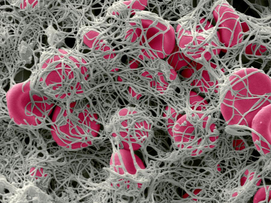 Blood clot, SEM #1 Photograph by Science Photo Library - STEVE GSCHMEISSNER.