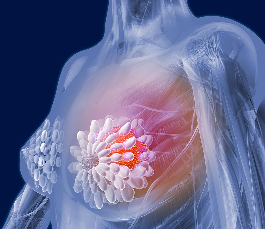 Breast cancer, artwork #1 Drawing by Science Photo Library - ROGER HARRIS