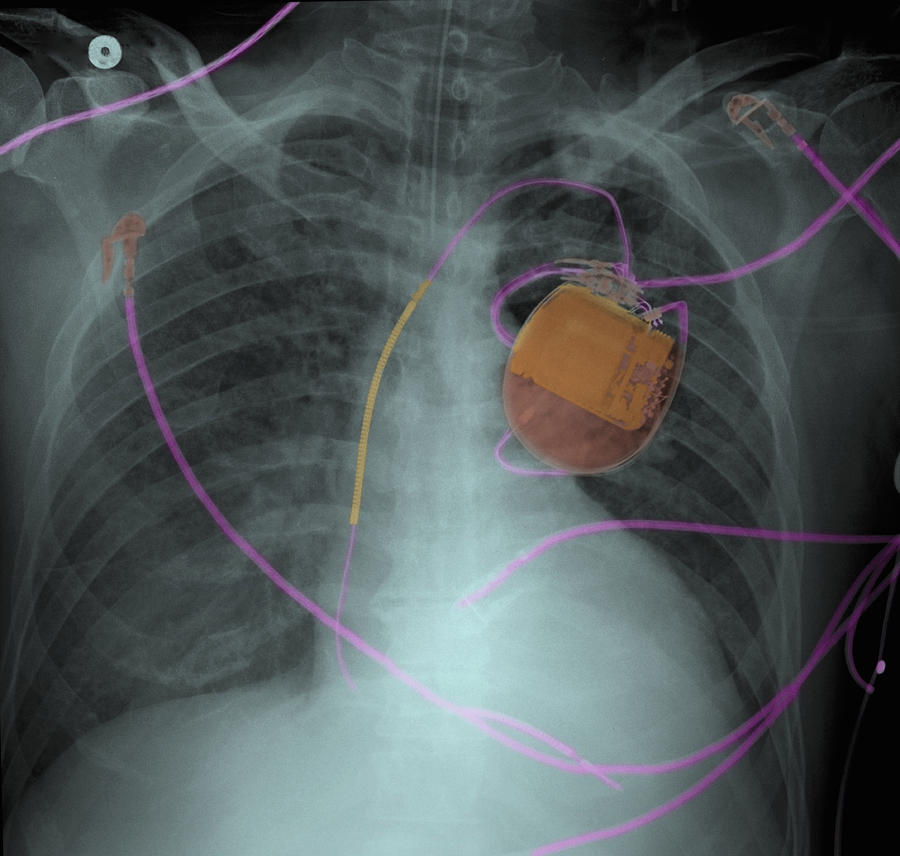 Chest x-ray of pacemaker and pulmonary edema #1 Photograph by Callista Images