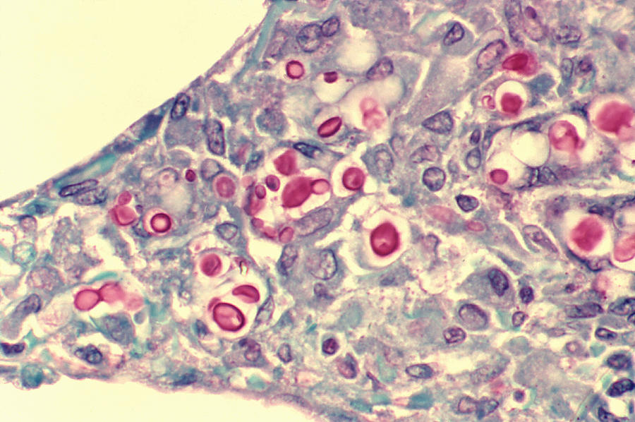 Cryptococcosis of lung in patient with AIDS #1 Photograph by Callista Images Cryptococcosis of lung in patient with AIDS #1 Photograph by Callista Images