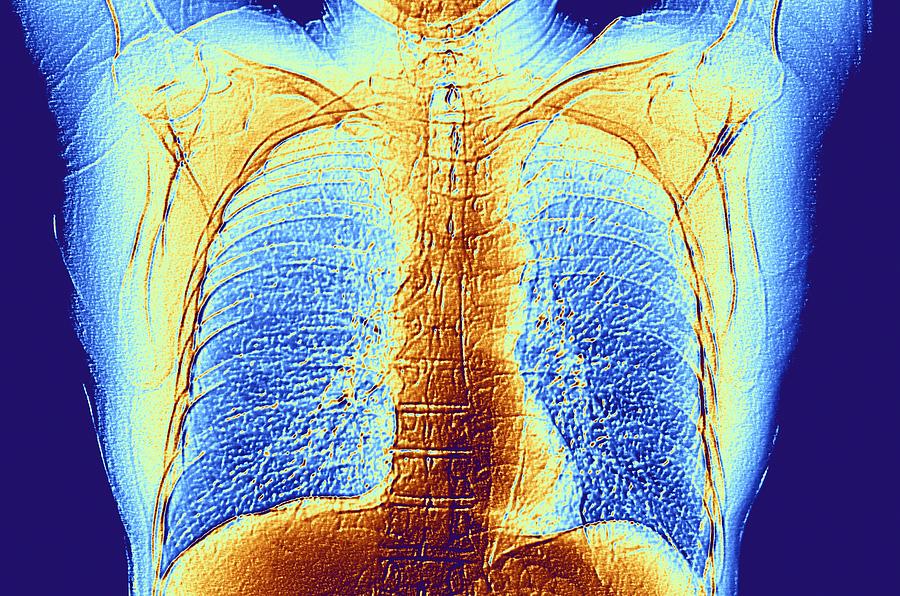CT scan of chest showing heart and lungs #1 Photograph by Alfred Pasieka/science Photo Library