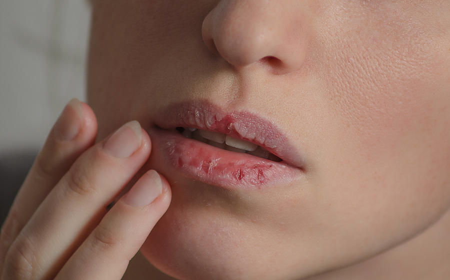 Dermatillomania skin picking. Woman has bad habit to pick her lips. Harmful addiction based on anxiety stress and dry lips. Excoriation disorder. Sick cracked damaged tissue. #1 Photograph by Tetiana Mandziuk