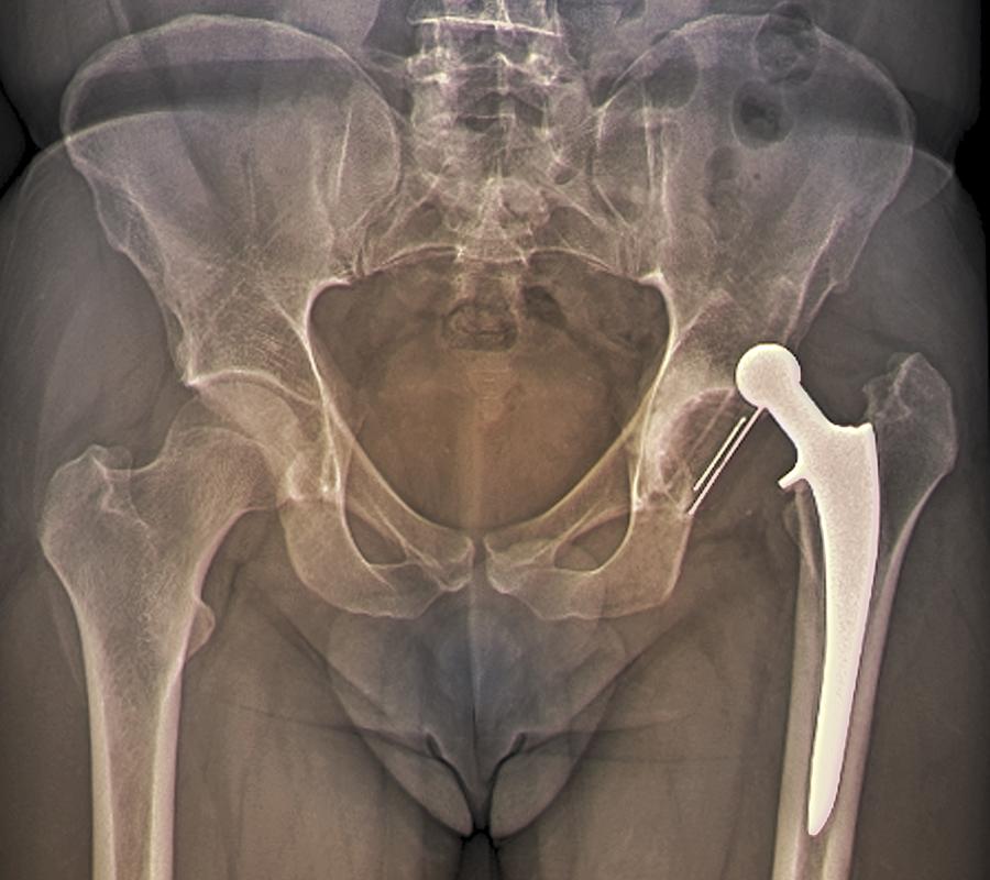 Dislocated hip replacement, X-ray #1 Photograph by Zephyr