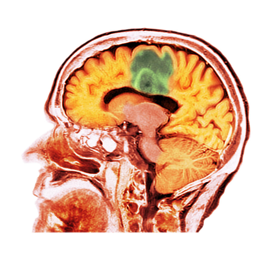 Glioblastoma brain cancer, CT scan Photograph by Dr P. Marazzi/science Photo Library