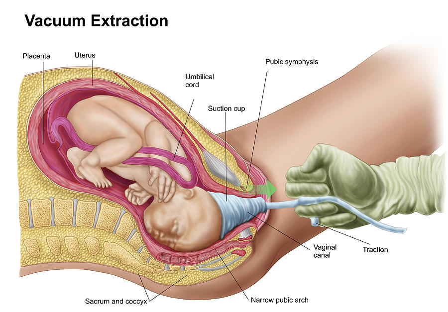 Illustration showing delivery of fetus using vacuum extraction. #1 Drawing by Stocktrek Images