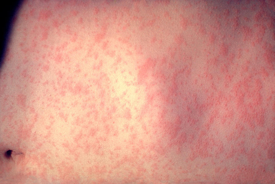 Measles Outbreaks Spread In U.S. Photograph by Handout Measles Outbreaks Spread In U.S. Photograph by Handout