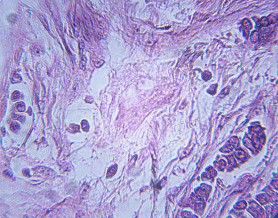 Microscopic Image of Breast Carcinoma #1 Photograph by Duncan Smith