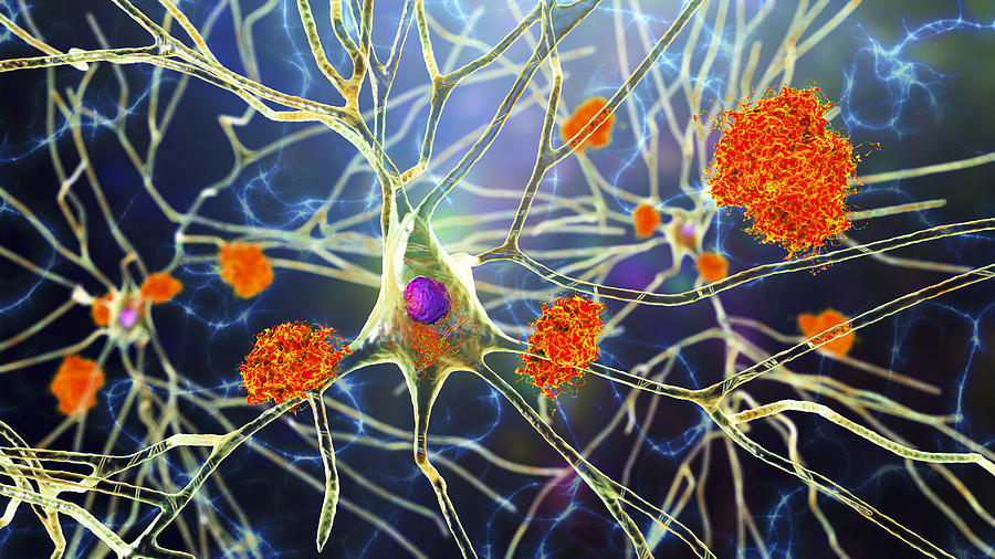 Nerve cells affected by Alzheimers disease, illustration #1 Drawing by Kateryna Kon/science Photo Library