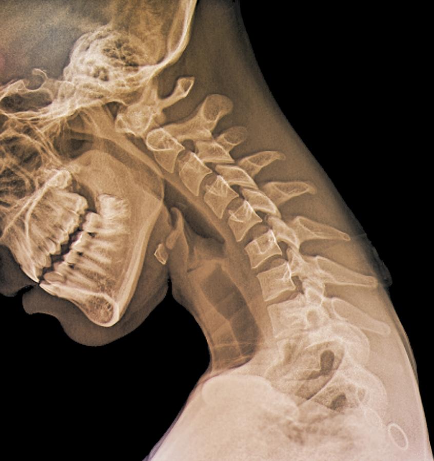 Normal flexed neck, X-ray #1 Photograph by Science Photo Library - ZEPHYR