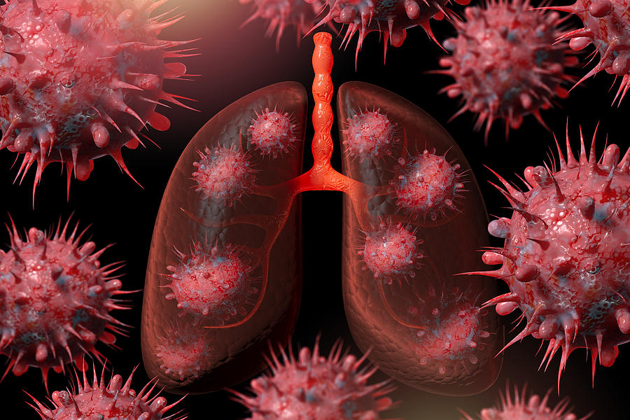 Omicron Sub-variant (BQ.1.1, BQ.1, BA.5, BF.7 and XBB.) infection in lungs, conceptual illustration. #1 Photograph by Uma Shankar sharma Omicron Sub-variant (BQ.1.1, BQ.1, BA.5, BF.7 and XBB.) infection in lungs, conceptual illustration. #1 Photograph by Uma Shankar sharma