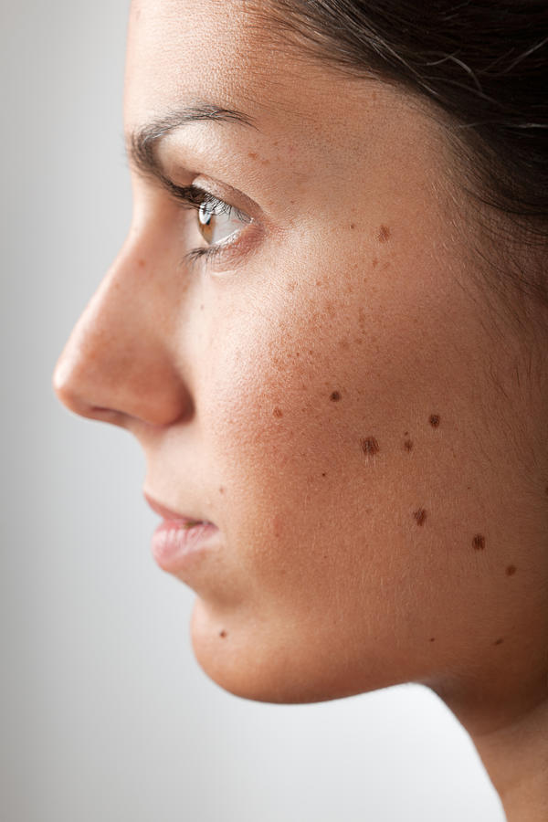 Portrait of a Woman with Melanoma Moles and Freckles (XXXL) #1 Photograph by 4fr