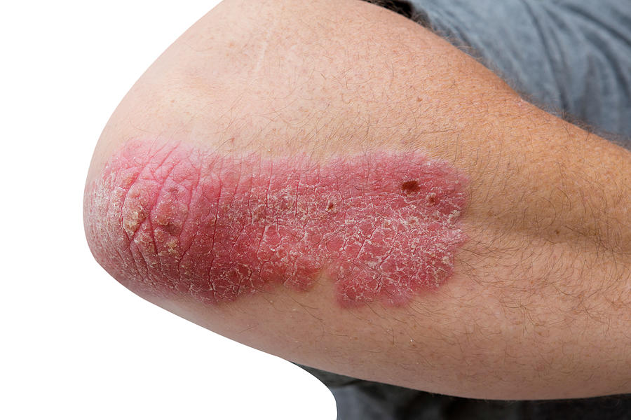 Psoriasis On A Mid Age Mans  Elbow #1 Photograph by JodiJacobson