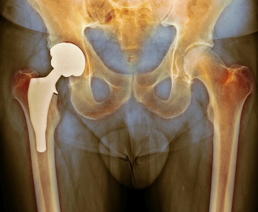Total hip replacement, X-ray #1 Photograph by Dr P. Marazzi/science Photo Library