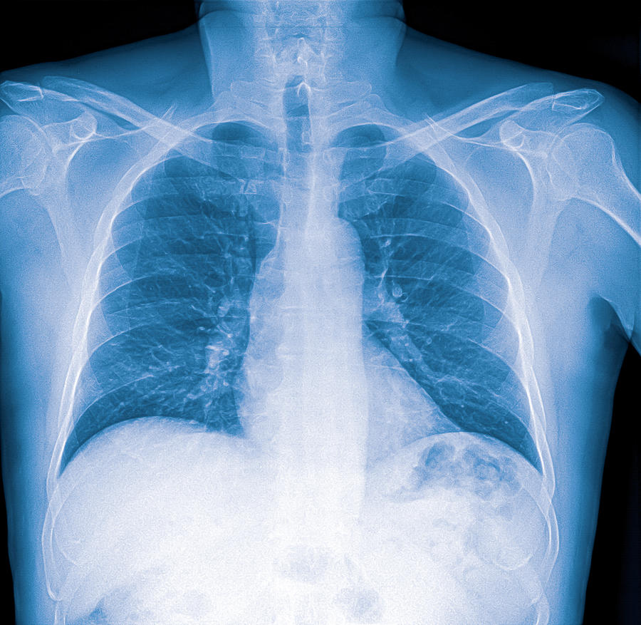 X-ray image of lung with pneumonia #1 Photograph by Nenov
