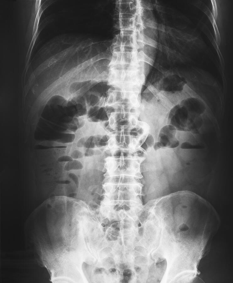 X-ray of the pelvis and spinal column #1 Photograph by Suradin