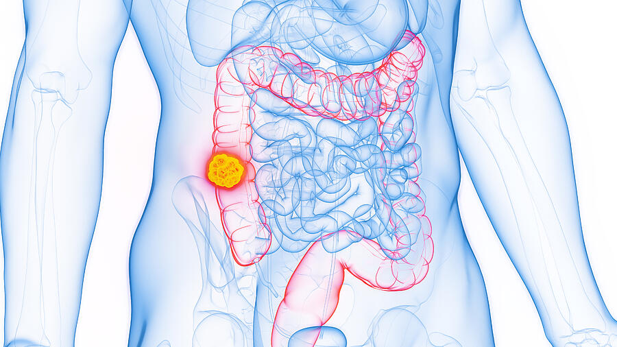 Colon cancer, illustration #14 Drawing by Sebastian Kaulitzki/science Photo Library Colon cancer, illustration #14 Drawing by Sebastian Kaulitzki/science Photo Library