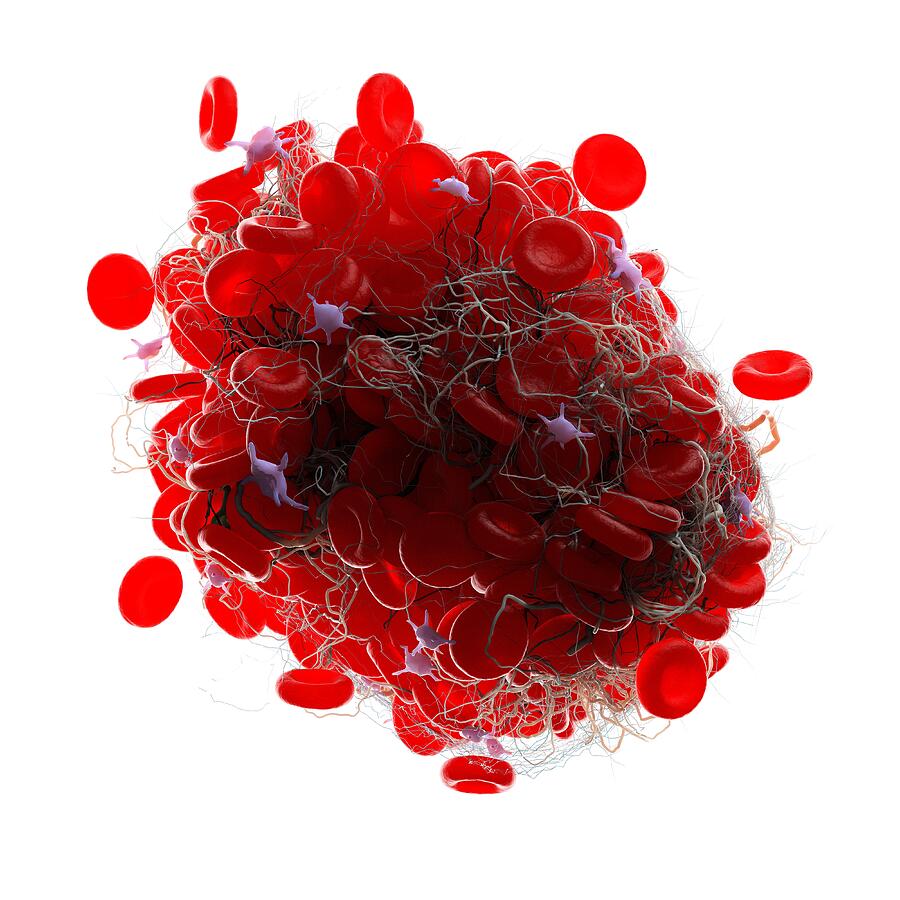 Blood clot, illustration #2 Drawing by Sebastian Kaulitzki/science Photo Library Blood clot, illustration #2 Drawing by Sebastian Kaulitzki/science Photo Library