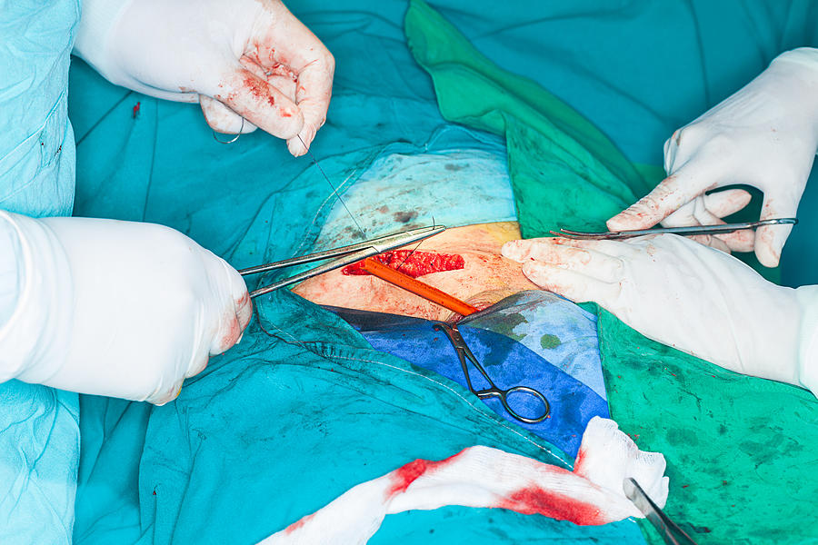 Inguinal Hernia Surgery #2 Photograph by PhotoGraphyKM