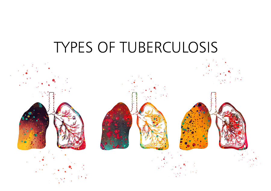 Tuberculosis Types Digital Art By Erzebet S - Pixels