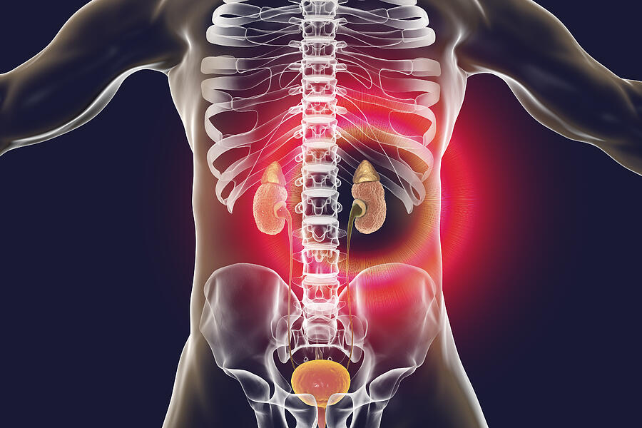 Chronic kidney disease, illustration #7 Drawing by Kateryna Kon/science Photo Library Chronic kidney disease, illustration #7 Drawing by Kateryna Kon/science Photo Library