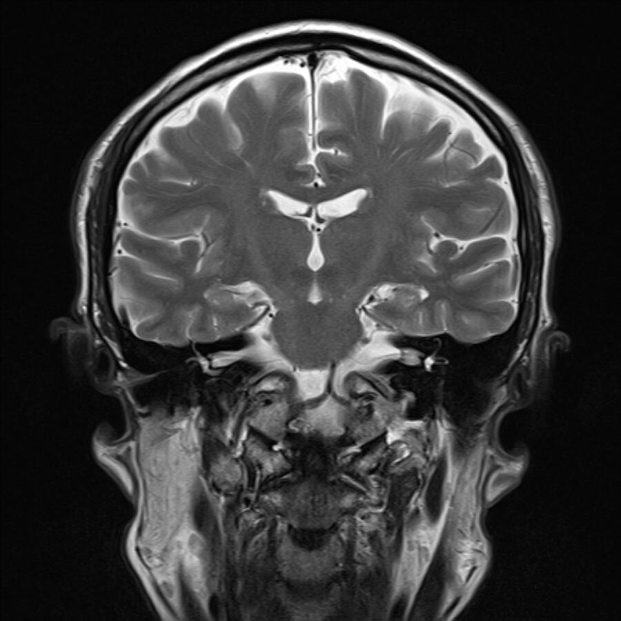 Healthy brain, MRI scan #7 Photograph by Rajaaisya/science Photo Library Healthy brain, MRI scan #7 Photograph by Rajaaisya/science Photo Library