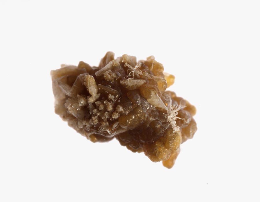 A human kidney stone after passage Photograph by Jonathan Kirn