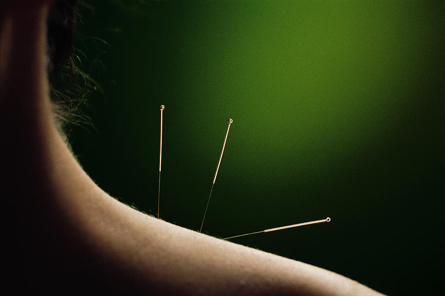 Acupuncture needles in neck and shoulder Photograph by Comstock