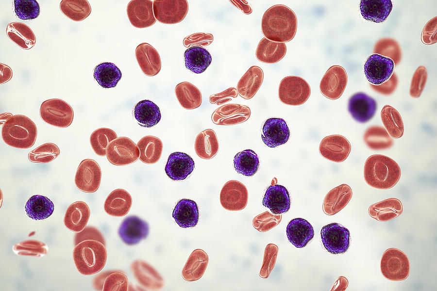 Acute lymphoblastic leukaemia, illustration Drawing by Kateryna Kon/science Photo Library