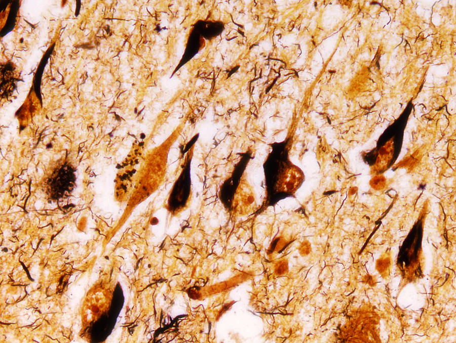 Alzheimers disease, neurofibrillary tangles Photograph by Ucsf