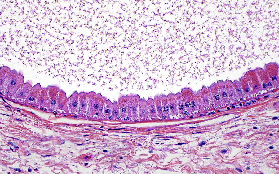 Apocrine Metaplasia Photograph By Ziad El-zaatari - Fine Art America