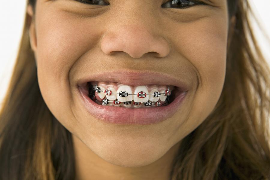 Asian girl smiling with braces Photograph by Caroline Schiff