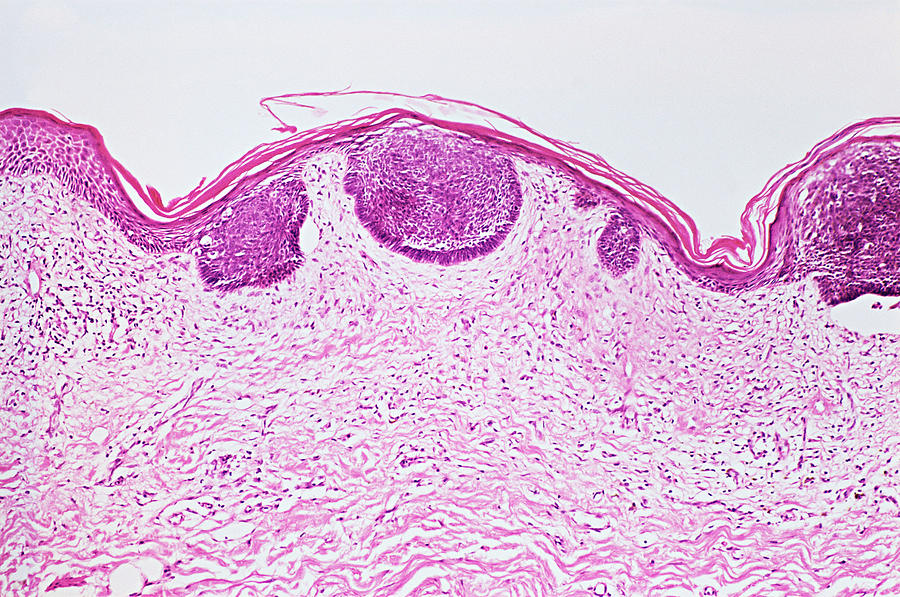 Basal cell carcinoma Photograph by Image Source