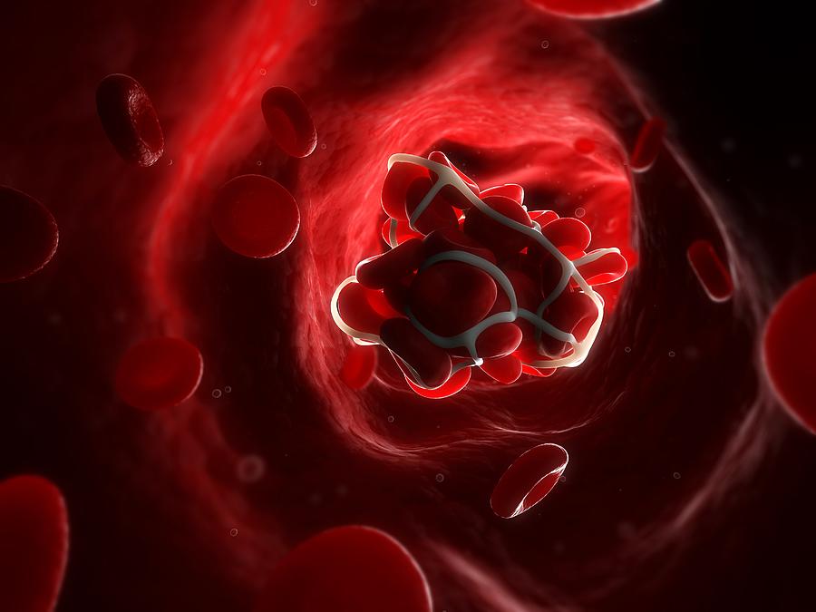 Blood clot, artwork Drawing by Science Photo Library - SCIEPRO