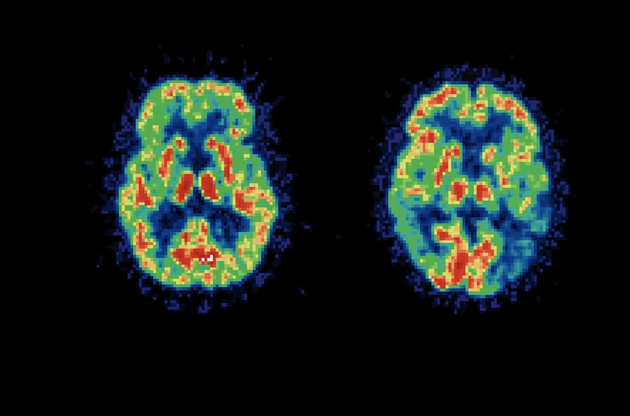 Brain Scan Comparison Photograph by Lawrence Berkeley National Library