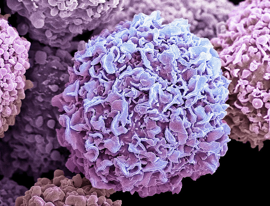 Breast cancer cells, SEM Photograph by Steve Gschmeissner/science Photo Library