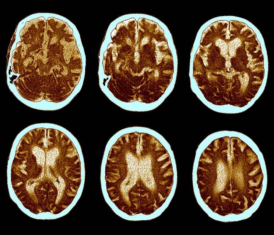 CAT scan of brain, Alzheimers disease Photograph by Science Photo Library - ZEPHYR.