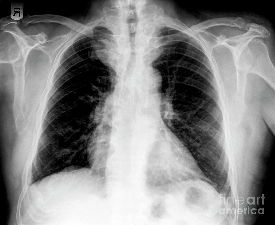 Chest x-ray n3 Photograph by Guy Viner - Fine Art America