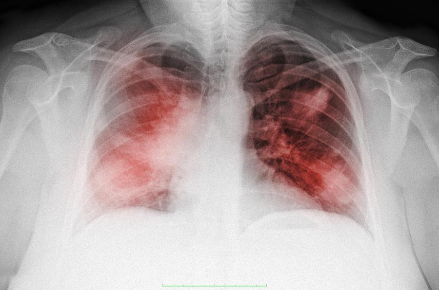 Chest x-ray of a 44 year old woman smoker, PA view, showing diffuse interstitial infiltrates suggestive of an atypical pneumonia Photograph by Callista Images