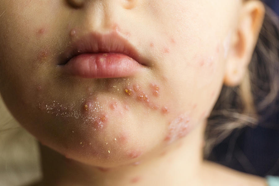 Chickenpox / varicella Photograph by Mixmike