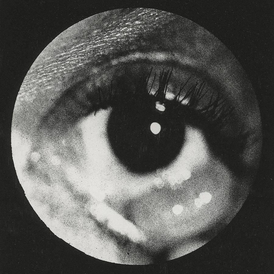 Clinical photograph of a cyst of conjunctiva Painting by Les Classics ...