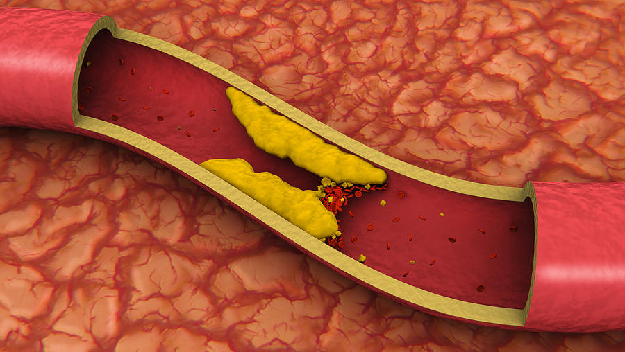 Clogged Artery (3D) Photograph by Jamesbenet