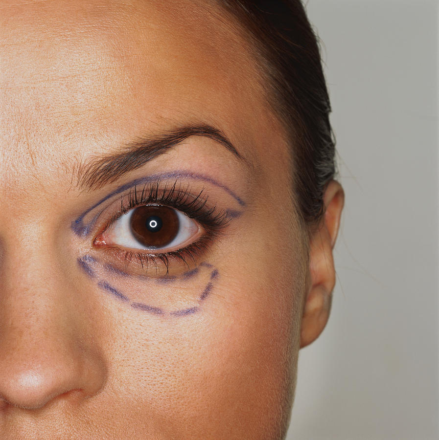 Close Up Of A Womans Eye Marked For Plastic Surgery Photograph by Stockbyte