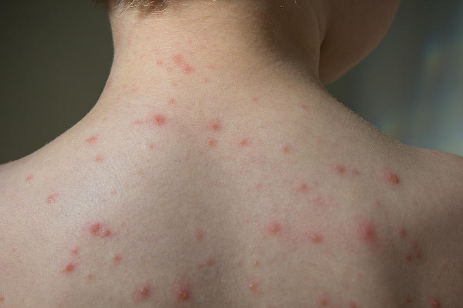Closeup of boys back full of chickenpox blisters Photograph by Tuomas Lehtinen