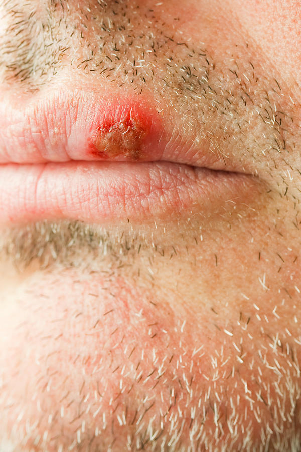 Cold Sore On The Lip Of A Middle Aged Male. Photograph by Scottjay