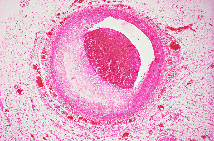 Coronary artery Photograph by Image Source