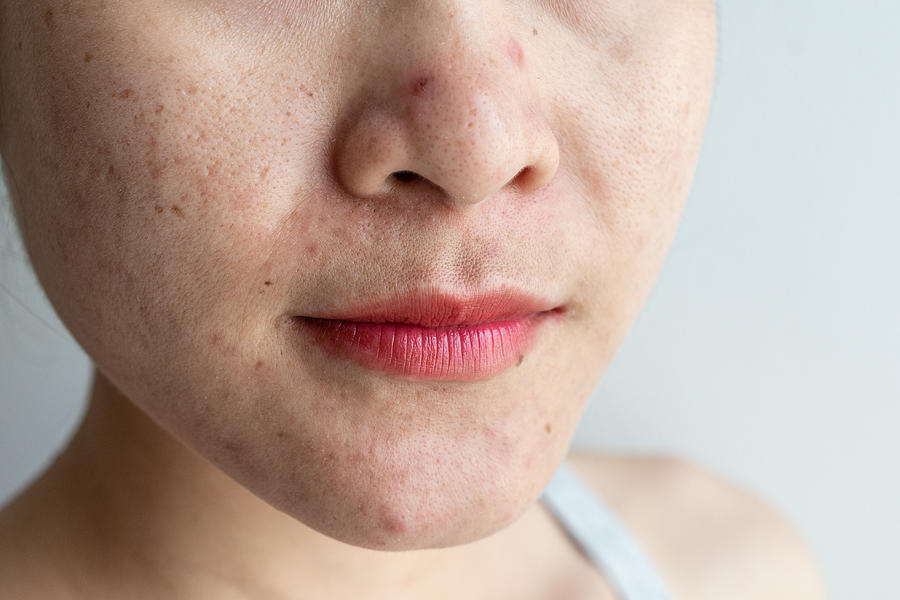 Cropped shot of woman having problems of acne inflamed on her face. Photograph by Boy_Anupong